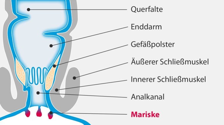 Marisken: Harmlose Analerkrankung Marisken: Harmlose Analerkrankung