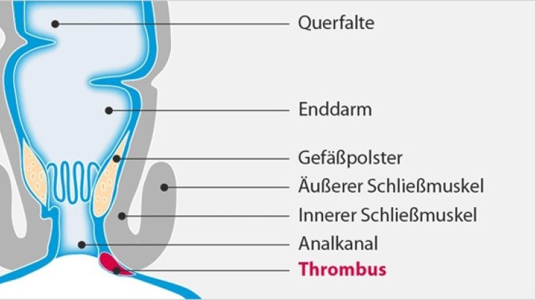 Analthrombose: Schmerzhafte Knubbel am After Analthrombose: Schmerzhafte Knubbel am After