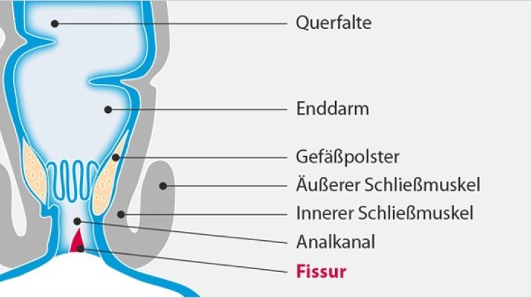 Analfissur: Häufige Analerkrankung Analfissur: Häufige Analerkrankung