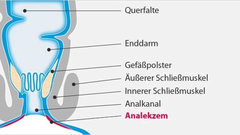 After juckt und brennt: Möglicherweise ein Analekzem After juckt und brennt: Möglicherweise ein Analekzem