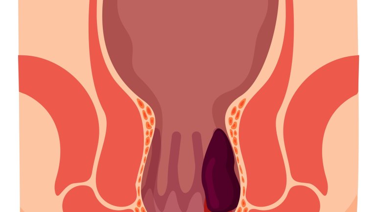 Hämorrhoiden: Häufige Analerkrankung Hämorrhoiden: Häufige Analerkrankung