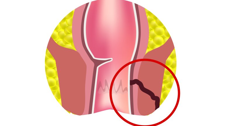Analfistel entsteht aus Analabszess Analfistel entsteht aus Analabszess
